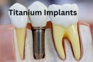 Titanium Implants – Procedure, Side Effects and Benefits