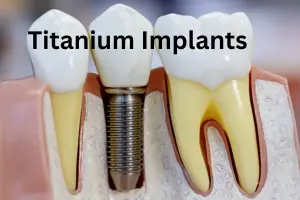 Titanium Implants – Procedure, Side Effects and Benefits